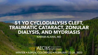 Case: 51 yo cyclodialysis cleft, traumatic cataract, zonular dialysis, and mydriasis"